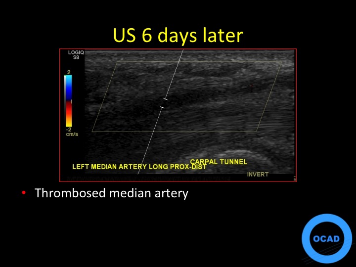 Figure 4 for case thrombus ( RID5037 )